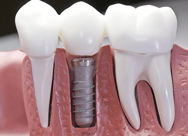 Імплантація зубів у Харкові