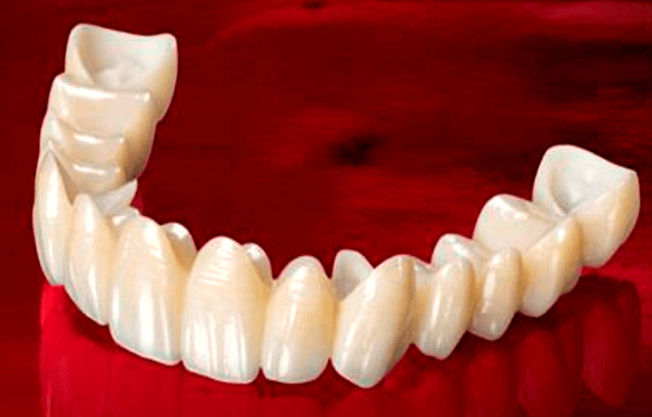 Безметалова кераміка для зубних коронок