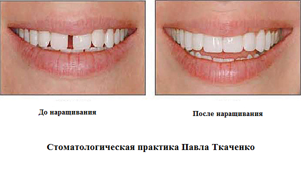 нарощування зубів