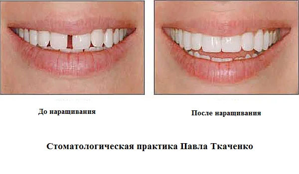 Протезирование на имплантах Харьков | Стоматология Dental Line