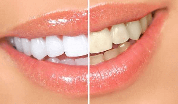 Методи відбілювання зубів