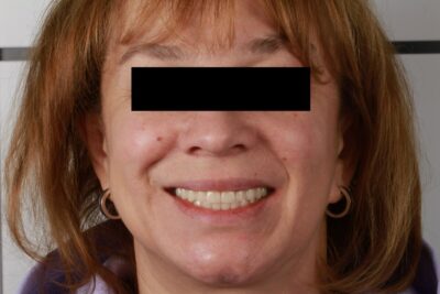 Тотальна реабілітація пацієнта на олл ін 4 з використанням цифри