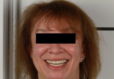 Тотальная реабилитация пациента на олл др. 4 с использованием цифры