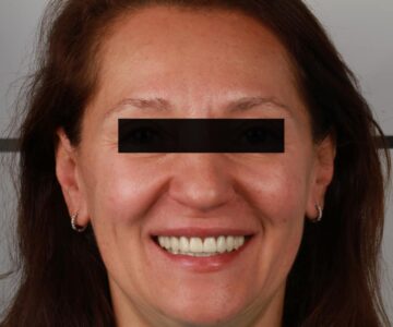 Адгезивні Керамічні Реставрації, Коронки на імплантах. Цифровий протокол