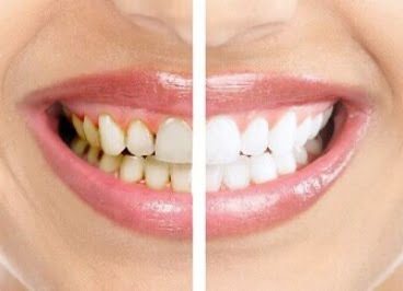 Чистка зубов в Харькове